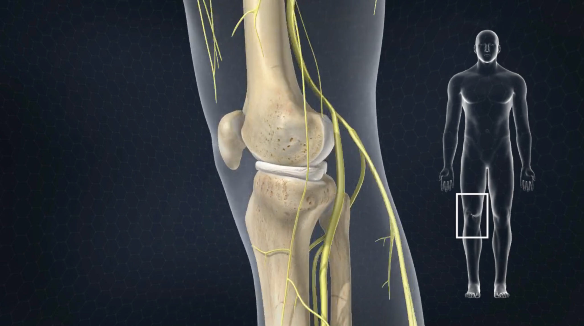 Nerve Ablations or Radiofrequency Rhizotomy in Des Moines, IA Central