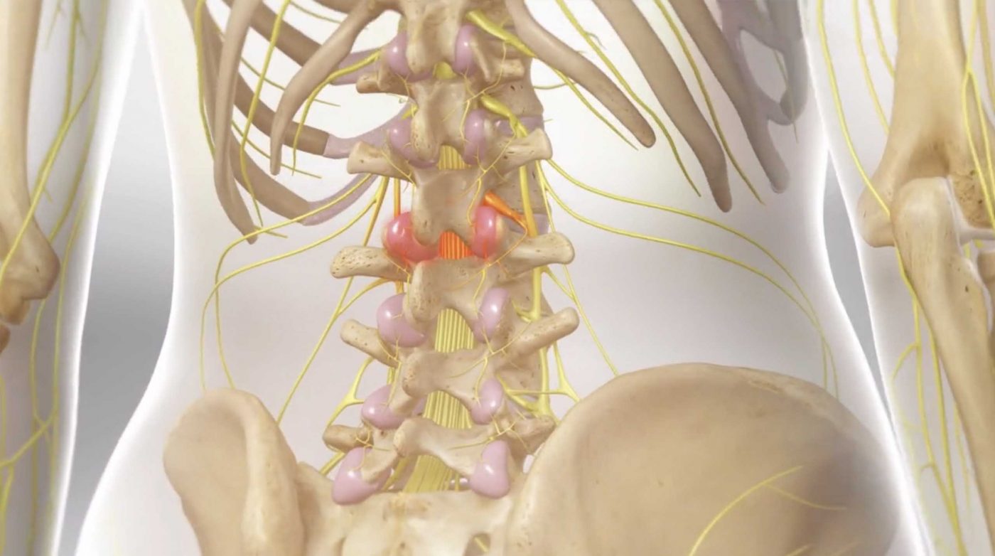 Lumbar (Low Back) Radiofrequency Ablation