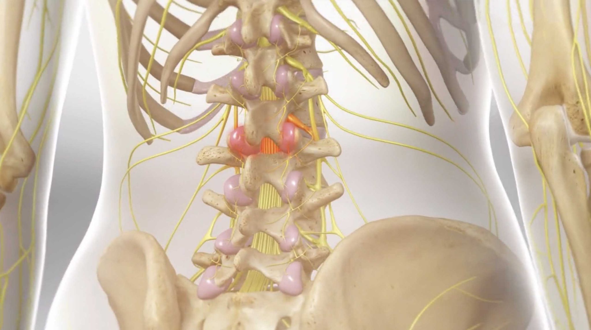 nerve-ablations-or-radiofrequency-rhizotomy-des-moines-iowa