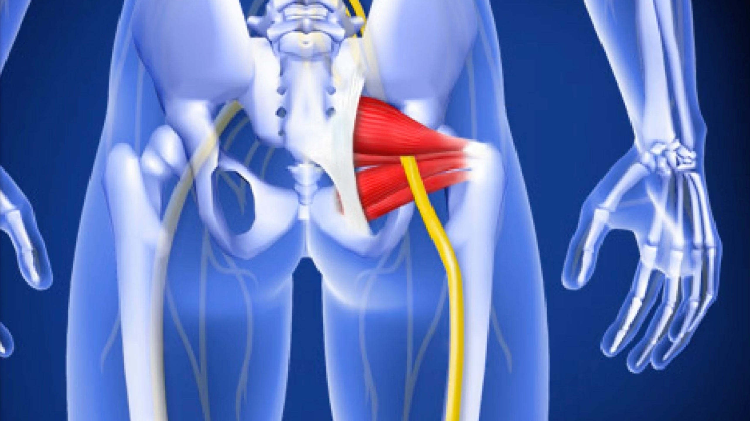 Injection For Piriformis Syndrome