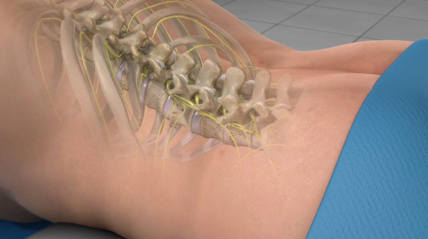Spinal Cord Stimulation (Trial and Permanent Placement)
