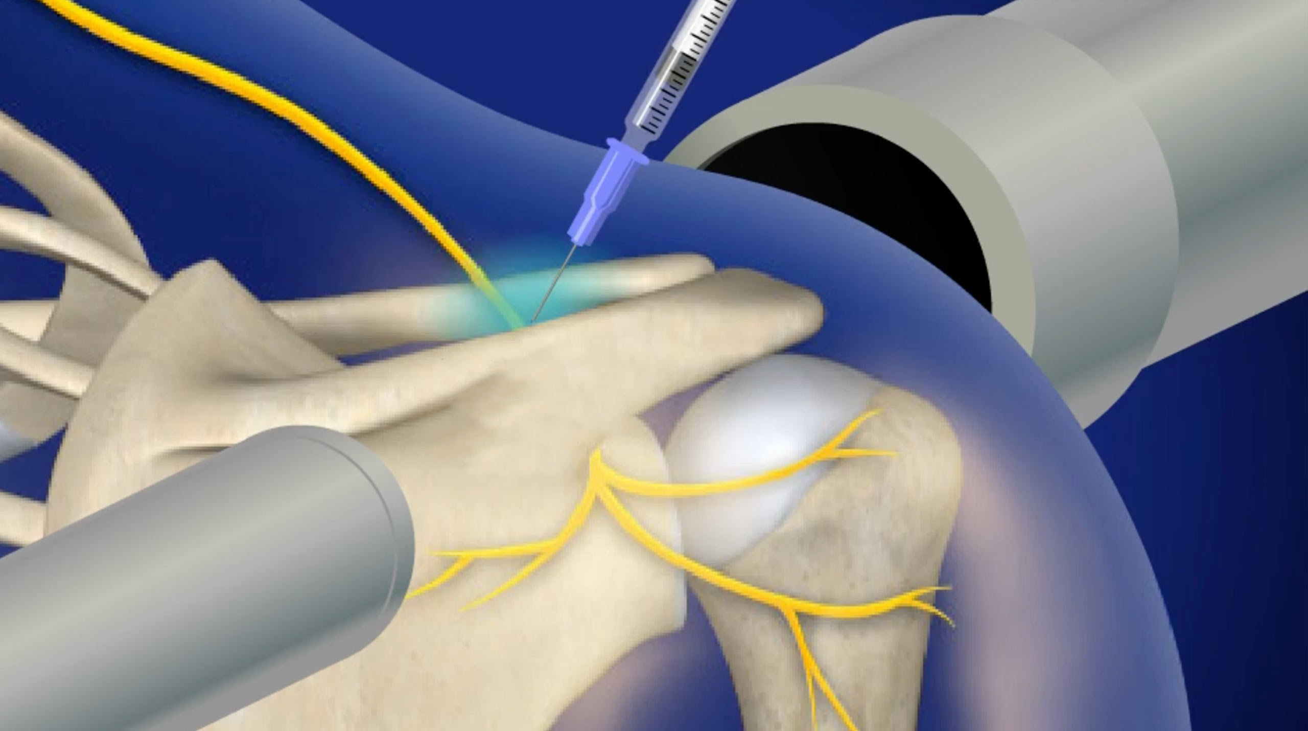 Suprascapular Nerve Block Iowa Fluoroscopically Guided