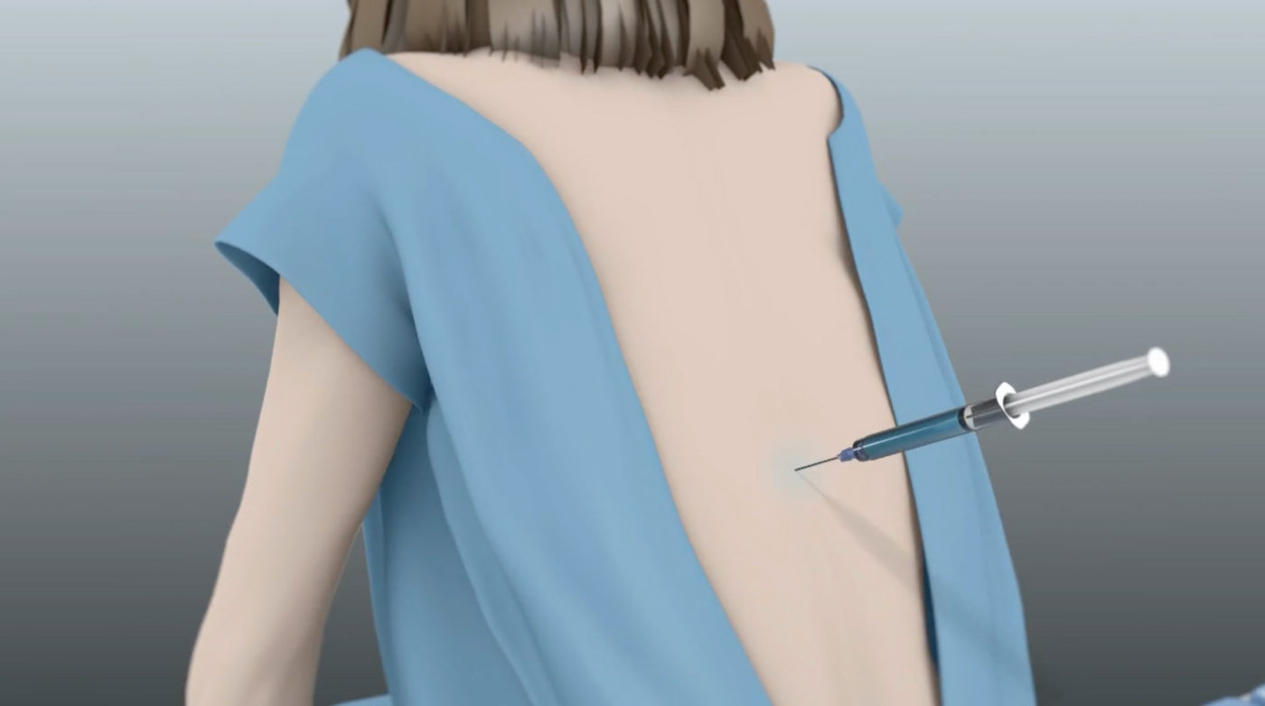 Thoracic (Upper And Mid Back) Epidural Steroid Injection