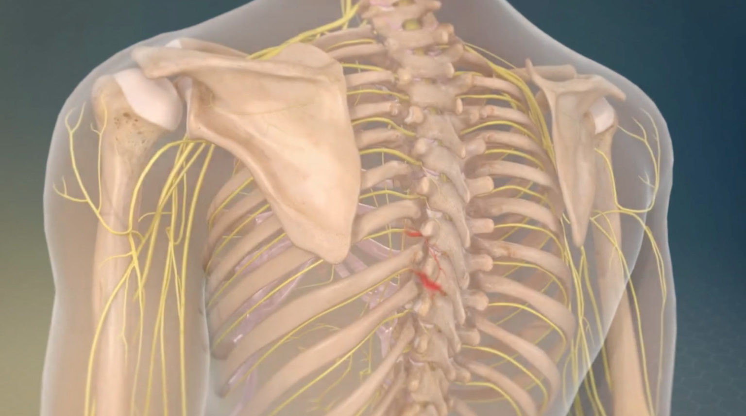 Nerve Ablations or Radiofrequency Rhizotomy in Des Moines, IA Central